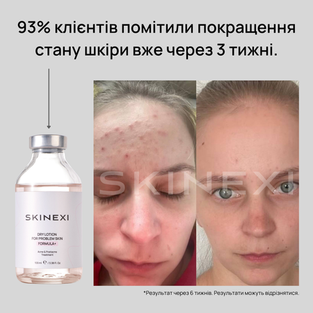 Розпродаж!!! Лосьйон від прищів та акне Skinexi Dry Lotion Formula+ 100 мл