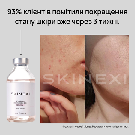 Розпродаж!!! Лосьйон від прищів та акне Skinexi Dry Lotion Formula+ 100 мл