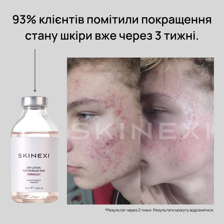 Розпродаж!!! Лосьйон від прищів та акне Skinexi Dry Lotion Formula+ 100 мл