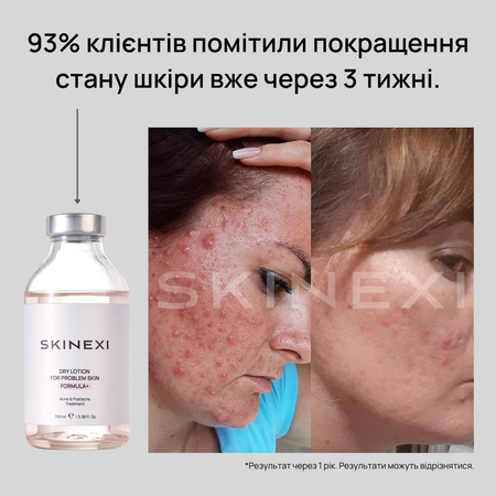 Розпродаж!!! Лосьйон від прищів та акне Skinexi Dry Lotion Formula+ 100 мл