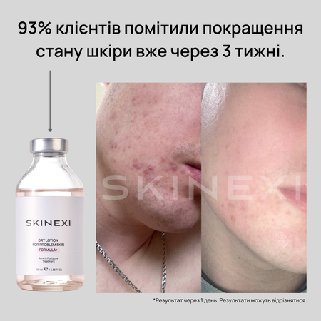 Розпродаж!!! Лосьйон від прищів та акне Skinexi Dry Lotion Formula+ 100 мл
