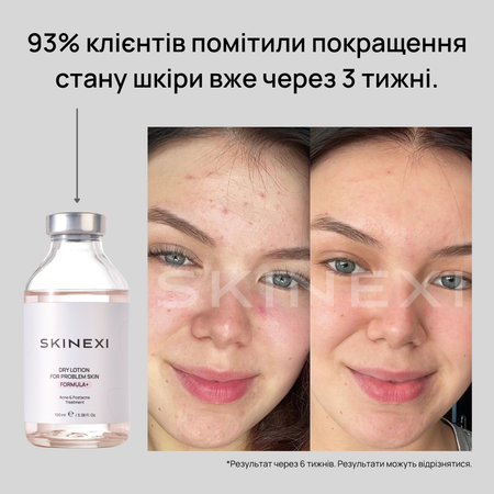 Розпродаж!!! Лосьйон від прищів та акне Skinexi Dry Lotion Formula+ 100 мл