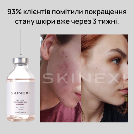 Розпродаж!!! Лосьйон від прищів та акне Skinexi Dry Lotion Formula+ 100 мл