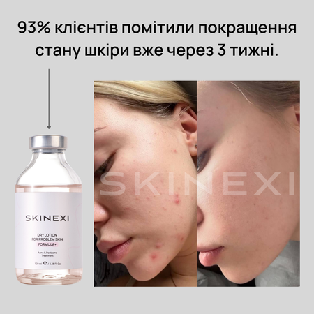 Розпродаж!!! Лосьйон від прищів та акне Skinexi Dry Lotion Formula+ 100 мл