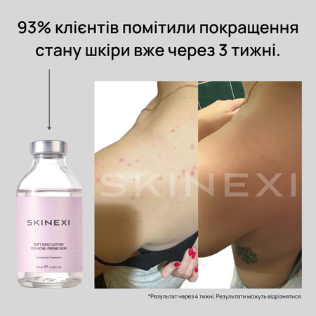 Распродажа!!! Лосьон от комедонов и чёрных точек Skinexi Soft Daily Lotion 100 мл