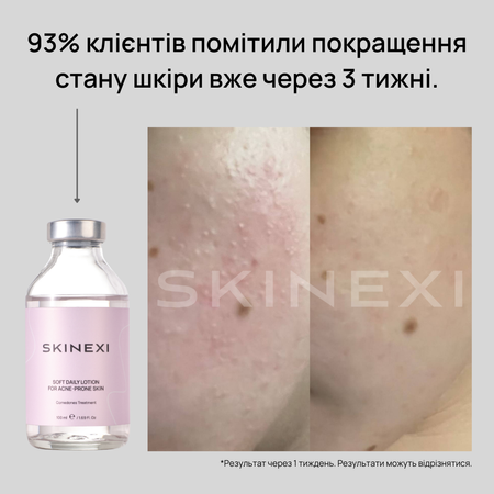Распродажа!!! Лосьон от комедонов и чёрных точек Skinexi Soft Daily Lotion 100 мл