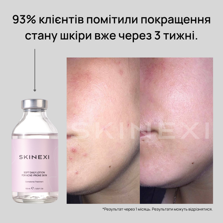Распродажа!!! Лосьон от комедонов и чёрных точек Skinexi Soft Daily Lotion 100 мл