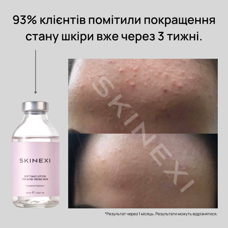 Распродажа!!! Лосьон от комедонов и чёрных точек Skinexi Soft Daily Lotion 100 мл