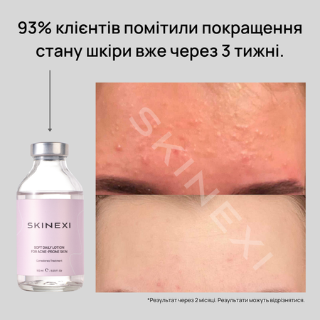 Распродажа!!! Лосьон от комедонов и чёрных точек Skinexi Soft Daily Lotion 100 мл