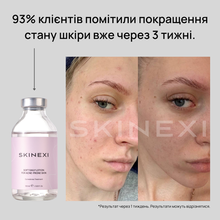 Распродажа!!! Лосьон от комедонов и чёрных точек Skinexi Soft Daily Lotion 100 мл