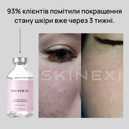 Распродажа!!! Лосьон от комедонов и чёрных точек Skinexi Soft Daily Lotion 100 мл