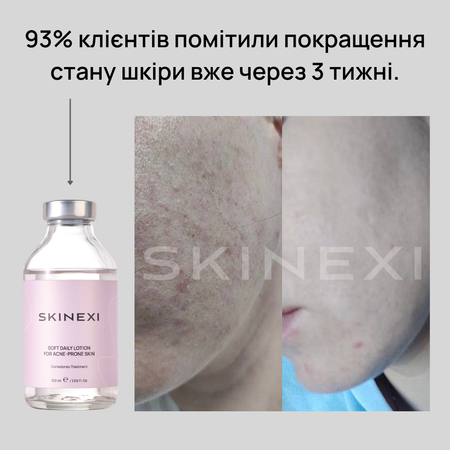 Распродажа!!! Лосьон от комедонов и чёрных точек Skinexi Soft Daily Lotion 100 мл