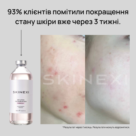 Розпродаж!!! Лосьйон від прищів та акне Skinexi Dry Lotion Formula+ 250 мл