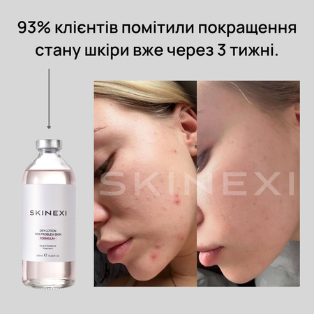 Розпродаж!!! Лосьйон від прищів та акне Skinexi Dry Lotion Formula+ 250 мл