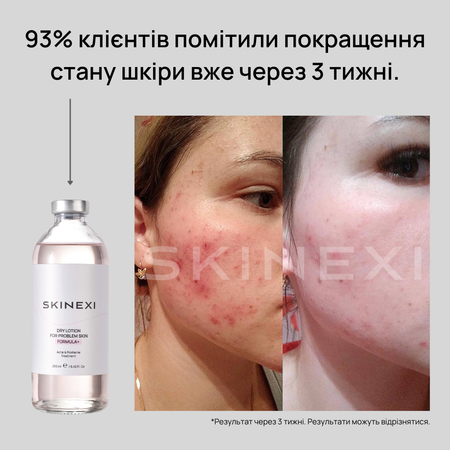 Розпродаж!!! Лосьйон від прищів та акне Skinexi Dry Lotion Formula+ 250 мл