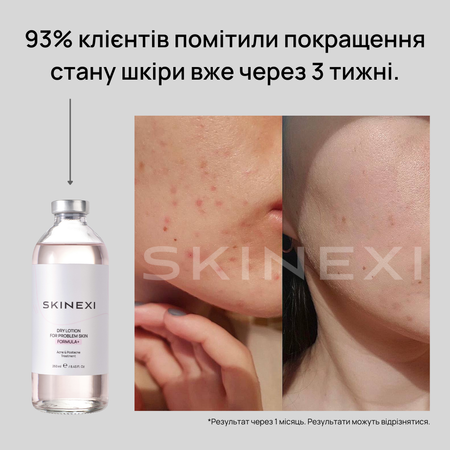 Розпродаж!!! Лосьйон від прищів та акне Skinexi Dry Lotion Formula+ 250 мл