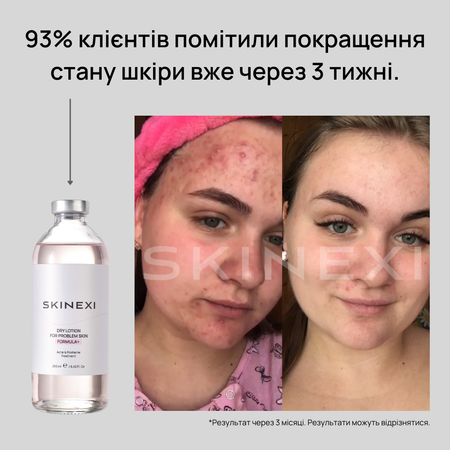Розпродаж!!! Лосьйон від прищів та акне Skinexi Dry Lotion Formula+ 250 мл