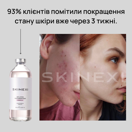 Розпродаж!!! Лосьйон від прищів та акне Skinexi Dry Lotion Formula+ 250 мл