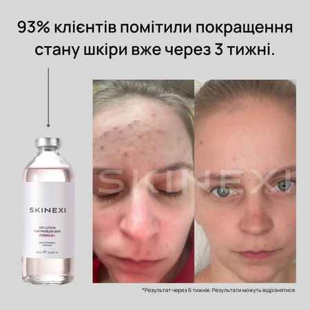 Розпродаж!!! Лосьйон від прищів та акне Skinexi Dry Lotion Formula+ 250 мл