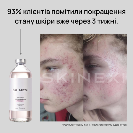 Розпродаж!!! Лосьйон від прищів та акне Skinexi Dry Lotion Formula+ 250 мл