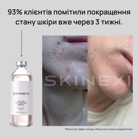Розпродаж!!! Лосьйон від прищів та акне Skinexi Dry Lotion Formula+ 250 мл