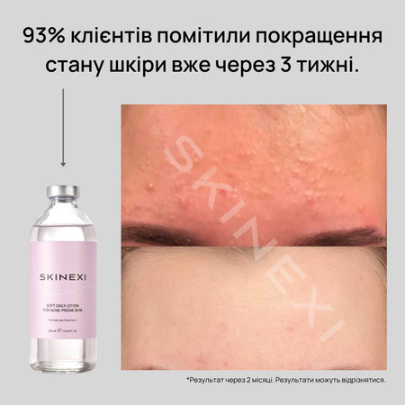 Распродажа!!! Лосьон от комедонов и чёрных точек Skinexi Soft Daily Lotion 250 мл