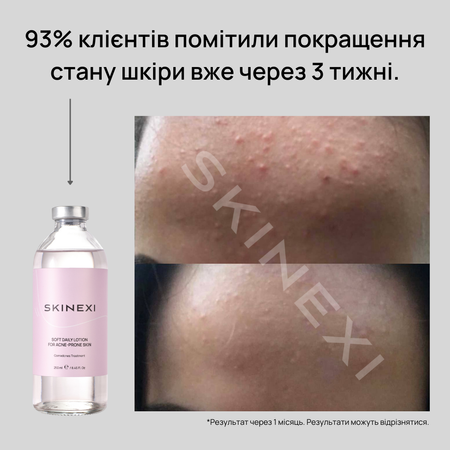 Распродажа!!! Лосьон от комедонов и чёрных точек Skinexi Soft Daily Lotion 250 мл