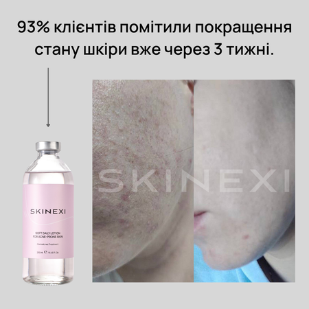 Распродажа!!! Лосьон от комедонов и чёрных точек Skinexi Soft Daily Lotion 250 мл